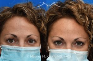 Photo of a patient before and after a procedure. Osteoma - This 43 year old had been bothered by the hard bony bump in the middle of her forehead. She travelled from out of town, for forehead osteoma removal in New York. She could not be more satisfied. The incision in the hairline is invisible six months after surgery. 