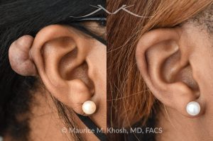 Photo of a patient before and after a procedure. Keloid of the ear