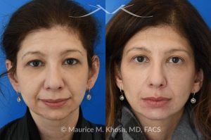 Photo of a patient before and after a procedure. Upper blepharoplasty - This 45 year old was interested in upper eyelid lift in Manhattan to address heavy and tired appearing upper eyelids. Upper blepharoplasty was carried out under local anesthesia as an office procedure. She had minimal bruising and no pain during her recovery. She is ecstatic with her results. 