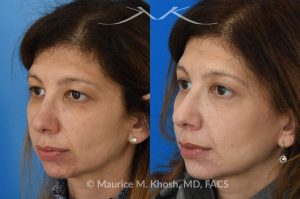 Photo of a patient before and after a procedure. Upper blepharoplasty - This 45 year old was interested in upper eyelid lift in Manhattan to address heavy and tired appearing upper eyelids. Upper blepharoplasty was carried out under local anesthesia as an office procedure. She had minimal bruising and no pain during her recovery. She is ecstatic with her results. 