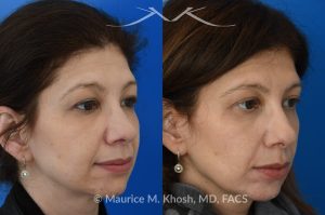 Photo of a patient before and after a procedure. Upper blepharoplasty - This 45 year old was interested in upper eyelid lift in Manhattan to address heavy and tired appearing upper eyelids. Upper blepharoplasty was carried out under local anesthesia as an office procedure. She had minimal bruising and no pain during her recovery. She is ecstatic with her results. 