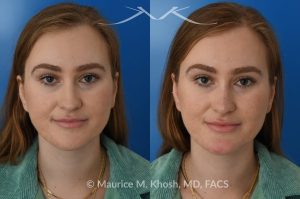 Photo of a patient before and after a procedure. Liquid rhinoplasty - This 25 year old was interested in non-surgical rhinoplasty in our New York office. She wanted to eliminate the hump in the bridge of her nose, and rotate the nasal tip. These before and after pictures demonstrate the dramatic effect of the treatment. 