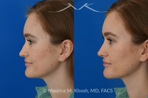 Photo of a patient before and after a procedure. Liquid rhinoplasty - This 25 year old was interested in non-surgical rhinoplasty in our New York office. She wanted to eliminate the hump in the bridge of her nose, and rotate the nasal tip. These before and after pictures demonstrate the dramatic effect of the treatment. 