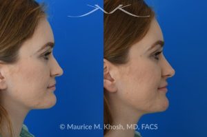 Photo of a patient before and after a procedure. Liquid rhinoplasty - This 25 year old was interested in non-surgical rhinoplasty in our New York office. She wanted to eliminate the hump in the bridge of her nose, and rotate the nasal tip. These before and after pictures demonstrate the dramatic effect of the treatment. 