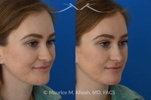 Photo of a patient before and after a procedure. Liquid rhinoplasty - This 25 year old was interested in non-surgical rhinoplasty in our New York office. She wanted to eliminate the hump in the bridge of her nose, and rotate the nasal tip. These before and after pictures demonstrate the dramatic effect of the treatment. 