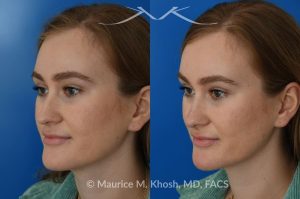 Photo of a patient before and after a procedure. Liquid rhinoplasty - This 25 year old was interested in non-surgical rhinoplasty in our New York office. She wanted to eliminate the hump in the bridge of her nose, and rotate the nasal tip. These before and after pictures demonstrate the dramatic effect of the treatment. 