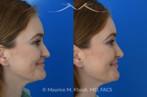 Photo of a patient before and after a procedure. Liquid rhinoplasty - This 25 year old was interested in non-surgical rhinoplasty in our New York office. She wanted to eliminate the hump in the bridge of her nose, and rotate the nasal tip. These before and after pictures demonstrate the dramatic effect of the treatment. 