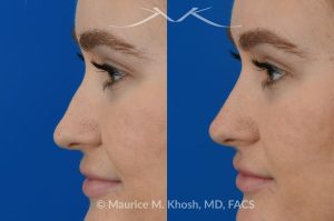 Photo of a patient before and after a procedure. Liquid rhinoplasty - This 25 year old was interested in non-surgical rhinoplasty in our New York office. She wanted to eliminate the hump in the bridge of her nose, and rotate the nasal tip. These before and after pictures demonstrate the dramatic effect of the treatment. 