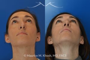 Photo of a patient before and after a procedure. Rhinoplasty - Crooked nose, nasal hump, hanging columella - This amazing 28 year-old had sustained a nose fracture at age eight which left her nose crooked to the left. She had severe nasal obstruction. Rhinoplasty though the open approach allowed correction of her crooked nose, smoothing of nasal hump, and push back of the hanging columella which was most notable on profile view.