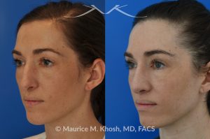 Photo of a patient before and after a procedure. Rhinoplasty - Crooked nose, nasal hump, hanging columella - This amazing 28 year-old had sustained a nose fracture at age eight which left her nose crooked to the left. She had severe nasal obstruction. Rhinoplasty though the open approach allowed correction of her crooked nose, smoothing of nasal hump, and push back of the hanging columella which was most notable on profile view.