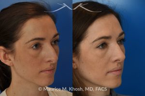 Photo of a patient before and after a procedure. Rhinoplasty - Crooked nose, nasal hump, hanging columella - This amazing 28 year-old had sustained a nose fracture at age eight which left her nose crooked to the left. She had severe nasal obstruction. Rhinoplasty though the open approach allowed correction of her crooked nose, smoothing of nasal hump, and push back of the hanging columella which was most notable on profile view.
