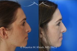 Photo of a patient before and after a procedure. Rhinoplasty - Crooked nose, nasal hump, hanging columella - This amazing 28 year-old had sustained a nose fracture at age eight which left her nose crooked to the left. She had severe nasal obstruction. Rhinoplasty though the open approach allowed correction of her crooked nose, smoothing of nasal hump, and push back of the hanging columella which was most notable on profile view.