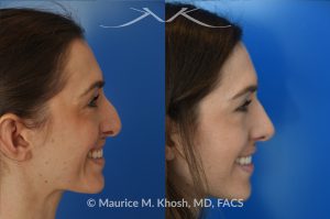 Photo of a patient before and after a procedure. Rhinoplasty - Crooked nose, nasal hump, hanging columella - This amazing 28 year-old had sustained a nose fracture at age eight which left her nose crooked to the left. She had severe nasal obstruction. Rhinoplasty though the open approach allowed correction of her crooked nose, smoothing of nasal hump, and push back of the hanging columella which was most notable on profile view.