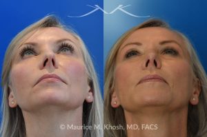 Photo of a patient before and after a procedure. Rhinoplasty - Crooked nose, small hump - This amazing 65 year-old had chronic severe right sided nasal obstruction, deviation of the nose to the left side, and a small nasal hump. Surgery to address her concerns included: open approach rhinoplasty, septoplasty, right sided spreader graft, right sided septum extension graft, and a small right sided alar strut graft. She is delighted with the improved breathing and the straight appearing nasal bridge. 