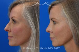 Photo of a patient before and after a procedure. Rhinoplasty - Crooked nose, small hump - This amazing 65 year-old had chronic severe right sided nasal obstruction, deviation of the nose to the left side, and a small nasal hump. Surgery to address her concerns included: open approach rhinoplasty, septoplasty, right sided spreader graft, right sided septum extension graft, and a small right sided alar strut graft. She is delighted with the improved breathing and the straight appearing nasal bridge. 