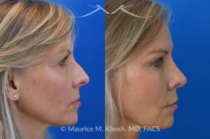 Photo of a patient before and after a procedure. Rhinoplasty - Crooked nose, small hump - This amazing 65 year-old had chronic severe right sided nasal obstruction, deviation of the nose to the left side, and a small nasal hump. Surgery to address her concerns included: open approach rhinoplasty, septoplasty, right sided spreader graft, right sided septum extension graft, and a small right sided alar strut graft. She is delighted with the improved breathing and the straight appearing nasal bridge. 