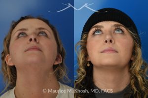 Photo of a patient before and after a procedure. Rhinoplasty - hump reduction, tip elevation - This amazing 22 year-old was bothered by the droopiness of the tip of her nose and the large nasal hump. We used the open approach to perform septoplasty, dorsal reduction, caudal septum shortening, cephalic trimming, and alar strut grafts. She is delighted with the improved breathing, and loves the new shape of her tip and the bridge of her nose. 