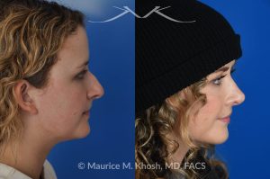 Photo of a patient before and after a procedure. Rhinoplasty - hump reduction, tip elevation - This amazing 22 year-old was bothered by the droopiness of the tip of her nose and the large nasal hump. We used the open approach to perform septoplasty, dorsal reduction, caudal septum shortening, cephalic trimming, and alar strut grafts. She is delighted with the improved breathing, and loves the new shape of her tip and the bridge of her nose. 