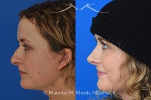 Photo of a patient before and after a procedure. Rhinoplasty - hump reduction, tip elevation - This amazing 22 year-old was bothered by the droopiness of the tip of her nose and the large nasal hump. We used the open approach to perform septoplasty, dorsal reduction, caudal septum shortening, cephalic trimming, and alar strut grafts. She is delighted with the improved breathing, and loves the new shape of her tip and the bridge of her nose. 