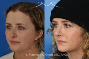 Photo of a patient before and after a procedure. Rhinoplasty - hump reduction, tip elevation - This amazing 22 year-old was bothered by the droopiness of the tip of her nose and the large nasal hump. We used the open approach to perform septoplasty, dorsal reduction, caudal septum shortening, cephalic trimming, and alar strut grafts. She is delighted with the improved breathing, and loves the new shape of her tip and the bridge of her nose. 