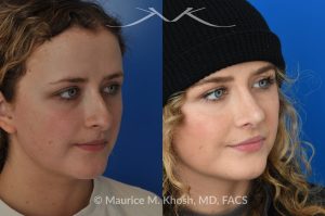 Photo of a patient before and after a procedure. Rhinoplasty - hump reduction, tip elevation - This amazing 22 year-old was bothered by the droopiness of the tip of her nose and the large nasal hump. We used the open approach to perform septoplasty, dorsal reduction, caudal septum shortening, cephalic trimming, and alar strut grafts. She is delighted with the improved breathing, and loves the new shape of her tip and the bridge of her nose. 