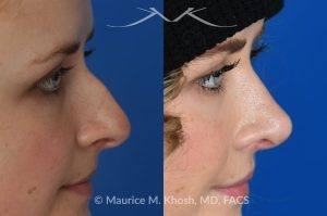 Photo of a patient before and after a procedure. Rhinoplasty - hump reduction, tip elevation - This amazing 22 year-old was bothered by the droopiness of the tip of her nose and the large nasal hump. We used the open approach to perform septoplasty, dorsal reduction, caudal septum shortening, cephalic trimming, and alar strut grafts. She is delighted with the improved breathing, and loves the new shape of her tip and the bridge of her nose. 