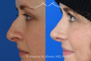 Photo of a patient before and after a procedure. Rhinoplasty - hump reduction, tip elevation - This amazing 22 year-old was bothered by the droopiness of the tip of her nose and the large nasal hump. We used the open approach to perform septoplasty, dorsal reduction, caudal septum shortening, cephalic trimming, and alar strut grafts. She is delighted with the improved breathing, and loves the new shape of her tip and the bridge of her nose. 