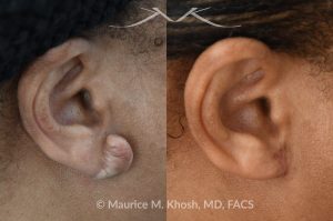 Photo of a patient before and after a procedure.  Dense keloid of right earlobe