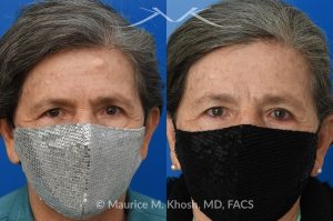 Photo of a patient before and after a procedure. Forehead Osteoma Removal