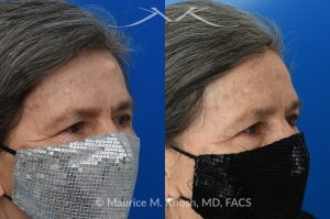 Photo of a patient before and after a procedure. Forehead Osteoma Removal