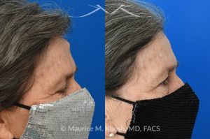 Photo of a patient before and after a procedure. Forehead Osteoma Removal