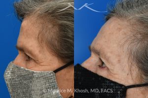 Photo of a patient before and after a procedure. Forehead Osteoma Removal
