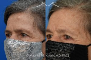 Photo of a patient before and after a procedure. Forehead Osteoma Removal