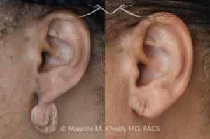 Photo of a patient before and after a procedure.  Dense keloid of right earlobe