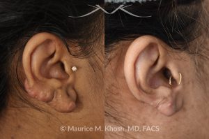 Photo of a patient before and after a procedure. Large dumble shaped keloid of right ear