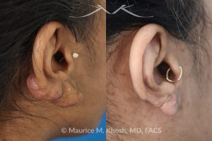 Photo of a patient before and after a procedure. Large dumble shaped keloid of right ear