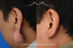 Photo of a patient before and after a procedure. Large hanging keloid of earlobe