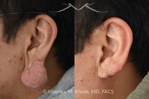 Photo of a patient before and after a procedure. Large hanging keloid of earlobe