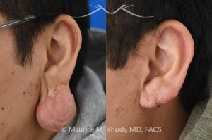 Photo of a patient before and after a procedure. Large hanging keloid of earlobe