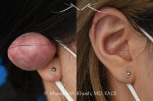 Photo of a patient before and after a procedure. Dense keloid of right upper ear