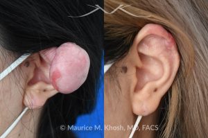 Photo of a patient before and after a procedure. Dense keloid of right upper ear