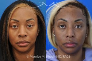 Photo of a patient before and after a procedure. Rhinoplasty to narrow nostrils and bridge of nose, neck liposuction 