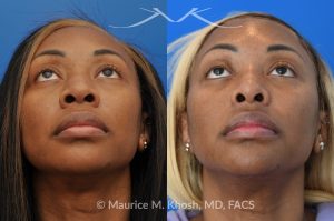 Photo of a patient before and after a procedure. Rhinoplasty to narrow nostrils and bridge of nose, neck liposuction 