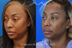 Photo of a patient before and after a procedure. Rhinoplasty to narrow nostrils and bridge of nose, neck liposuction