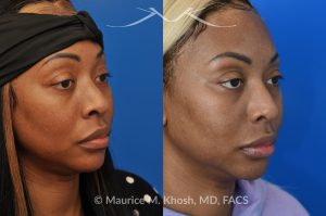 Photo of a patient before and after a procedure. Rhinoplasty to narrow nostrils and bridge of nose, neck liposuction