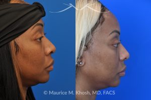 Photo of a patient before and after a procedure. Rhinoplasty to narrow nostrils and bridge of nose, neck liposuction 