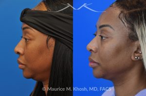 Photo of a patient before and after a procedure. Rhinoplasty to narrow nostrils and bridge of nose, neck liposuction