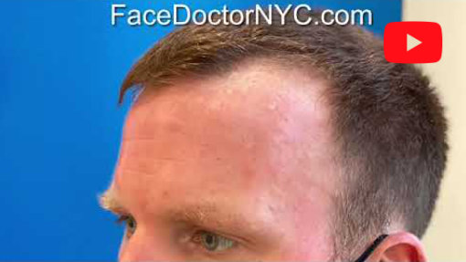 YouTube video titled NYC Hair Transplant | Follicular Unit Extraction FUE Upper East Side | Dr. Maurice Khosh New York