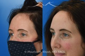Photo of a patient before and after a procedure. Osteoma Removal - This 43 year old sought treatment for forehead osteoma in our New York office. She had the osteoma present for 20 years. The osteoma removal was performed in the office under local anesthesia. 

