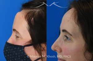 Photo of a patient before and after a procedure. Osteoma Removal - This 43 year old sought treatment for forehead osteoma in our New York office. She had the osteoma present for 20 years. The osteoma removal was performed in the office under local anesthesia. 

